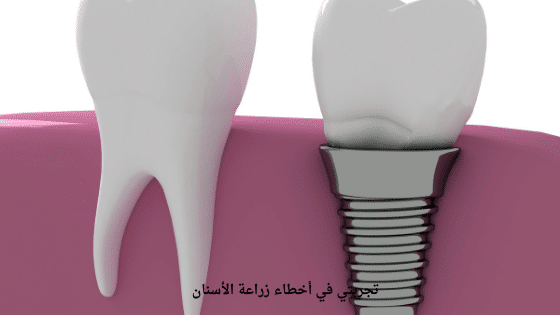 تجربتي في أخطاء زراعة الأسنان