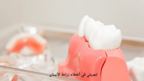تجربتي في أخطاء زراعة الأسنان