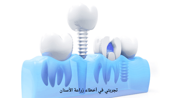 تجربتي في أخطاء زراعة الأسنان