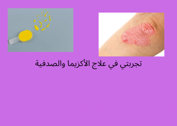 علاج الاكزيما والصدفية